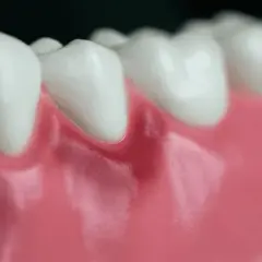 Zapalenie dziąseł: Ile trwa leczenie? Odpowiedź dentysty!