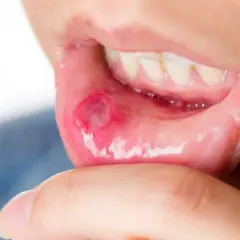 Afta w ustach a dentysta: Czy wizyta jest możliwa? Decyzja krok po kroku
