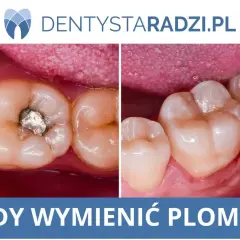 Porównanie zęba z plombą i bez. Widoczny mały ubytek w zębie po lewej, po prawej zdrowy ząb.