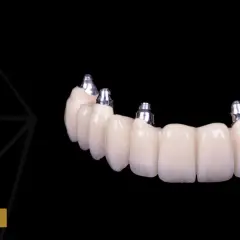 Wstawienie zęba: Implant, most, proteza? Poznaj koszty i wybierz!