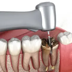 Ekstrakcja zęba z ropniem: Czy to możliwe? Kiedy dentysta usunie ząb?