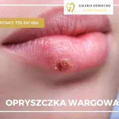 Wizyta u dentysty z opryszczką? Kiedy jest bezpieczna i co robić?