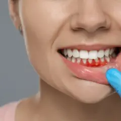 Wzmocnienie dziąseł: dieta, higiena i apteka kompleksowy poradnik