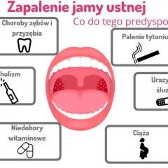 Jak szybko złagodzić zapalenie w jamie ustnej? Domowe i apteczne metody