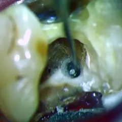 Ząb z odsłoniętą miazgą, gdzie narzędzie dentystyczne pracuje w kanale korzeniowym.