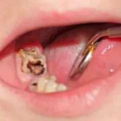 Widoczna duża dziura w zębie, z próchnicą i resztkami jedzenia. Dentysta bada ząb.