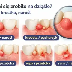 Ilustracja pokazuje zmiany na dziąśle: guzek, krostkę, ropę i przetokę. W przypadku ropy i przetoki, jaki antybiotyk na ząb z ropą jest najlepszy?