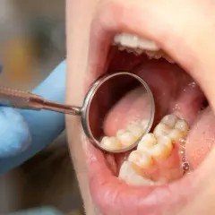 Dentysta bada zęby, widoczne są oznaki próchnicy między zębami.