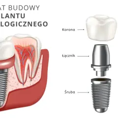 Ile kosztuje implant zęba? Pełny przewodnik po cenach i kosztach