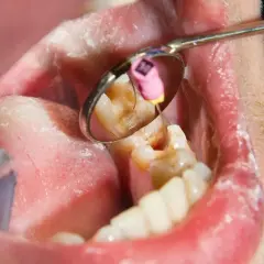 Widok jamy ustnej z lusterkiem dentystycznym. W odbiciu widać ząb z narzędziem, sugerującym leczenie ropnia zęba.