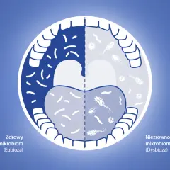 Ilustracja porównuje zdrowy i niezrównoważony mikrobiom jamy ustnej. Płyny do płukania jamy ustnej skutki uboczne mogą prowadzić do dysbiozy.