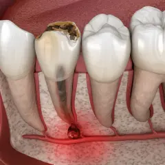 Zepsuty ząb z zapaleniem wierzchołka korzenia. To pokazuje, czym jest endodoncja – leczenie kanałowe.