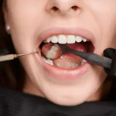 Uśmiech z widocznymi, białymi zębami, w tym siódemki, badany przez dentystę w czarnych rękawiczkach przy użyciu lusterka i sondy.