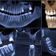 CBCT co to? Wielopłaszczyznowe badanie zębów i szczęki, pokazujące szczegółowo strukturę kostną i uzębienie.
