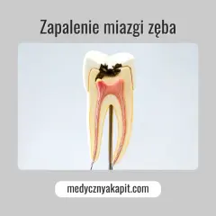 Model zęba z próchnicą i widoczną miazgą. Zapalenie miazgi zęba jak uśmierzyć ból.