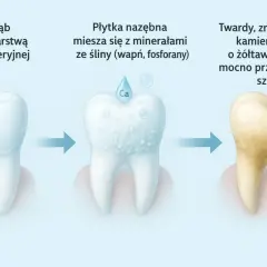 Ilustracja pokazuje, skąd się bierze kamień na zębach: płytka bakteryjna miesza się z minerałami ze śliny, tworząc twardy, żółtawy kamień nazębny.