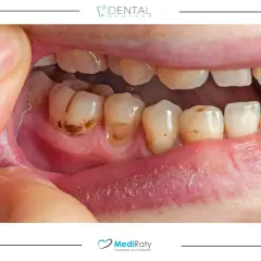 Domowe sposoby na próchnicę: Co naprawdę działa, zanim pójdziesz do dentysty?