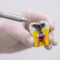 Model zęba z widoczną próchnicą zaawansowaną, gdzie narzędzie dentystyczne bada zniszczone tkanki.