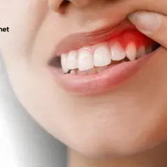 Stan zapalny dziąseł: Jak skutecznie leczyć w domu i u dentysty?