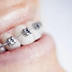 Aparat na zęby: Czy zawsze na wszystkie? Kiedy wystarczy jeden łuk?