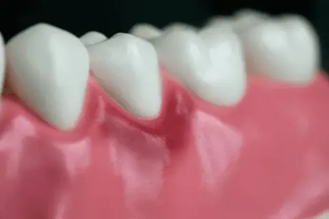 Zapalenie dziąseł: Ile trwa leczenie? Odpowiedź dentysty!