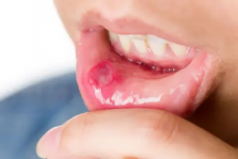 Afta w ustach a dentysta: Czy wizyta jest możliwa? Decyzja krok po kroku