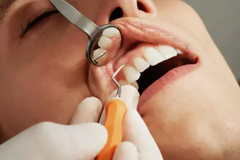Dentysta wykonuje skaling zębów, używając narzędzi i lusterka stomatologicznego.