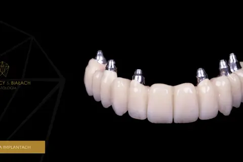 Wstawienie zęba: Implant, most, proteza? Poznaj koszty i wybierz!