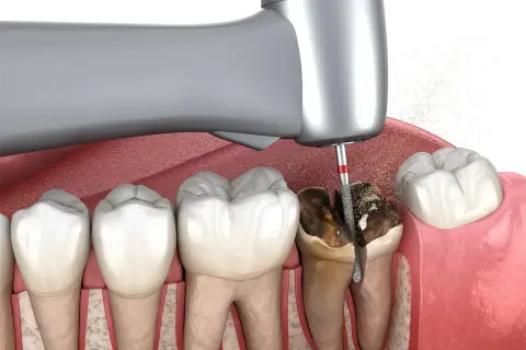 Ekstrakcja zęba z ropniem: Czy to możliwe? Kiedy dentysta usunie ząb?