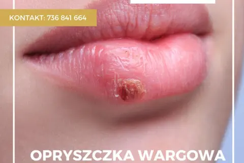 Wizyta u dentysty z opryszczką? Kiedy jest bezpieczna i co robić?