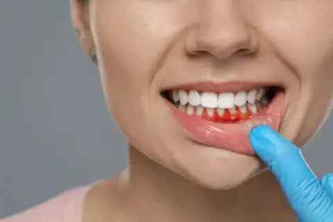 Wzmocnienie dziąseł: dieta, higiena i apteka kompleksowy poradnik