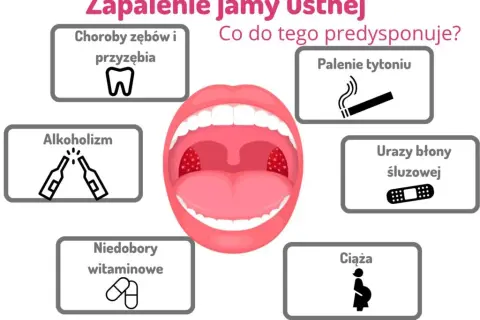Jak szybko złagodzić zapalenie w jamie ustnej? Domowe i apteczne metody
