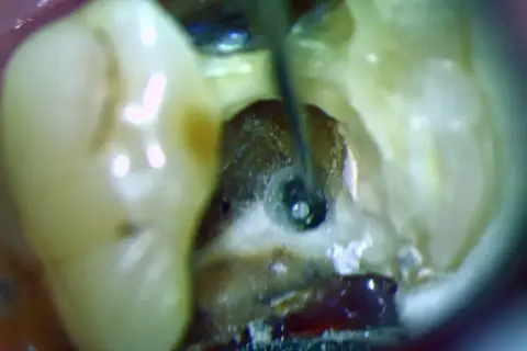 Ząb z odsłoniętą miazgą, gdzie narzędzie dentystyczne pracuje w kanale korzeniowym.