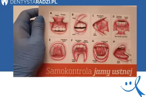 Rak jamy ustnej: Jak rozpoznać objawy i ratować życie? Poradnik