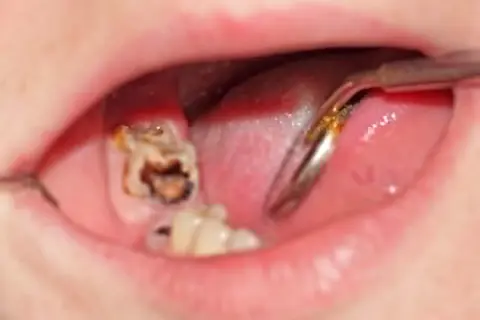Widoczna duża dziura w zębie, z próchnicą i resztkami jedzenia. Dentysta bada ząb.