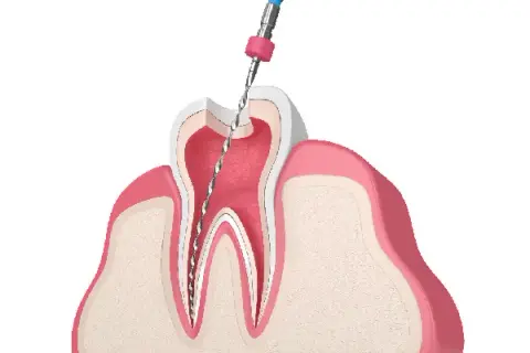 Ból zęba? Sprawdź, czy to leczenie kanałowe i kiedy do dentysty