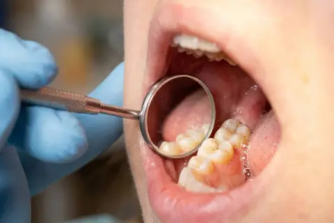 Dentysta bada zęby, widoczne są oznaki próchnicy między zębami.