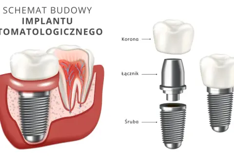 Ile kosztuje implant zęba? Pełny przewodnik po cenach i kosztach