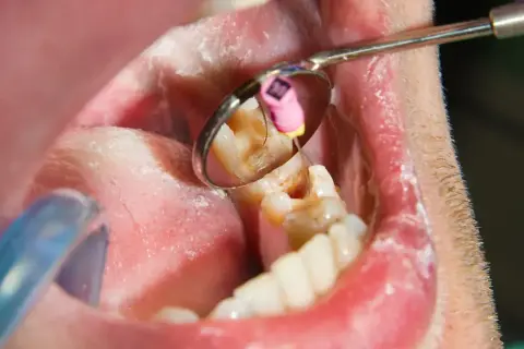 Widok jamy ustnej z lusterkiem dentystycznym. W odbiciu widać ząb z narzędziem, sugerującym leczenie ropnia zęba.