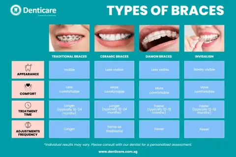 Porównanie aparatów na zęby ludzkie: tradycyjny, ceramiczny, Damon i Invisalign. Różnice w wyglądzie, komforcie, czasie leczenia i częstotliwości wizyt.