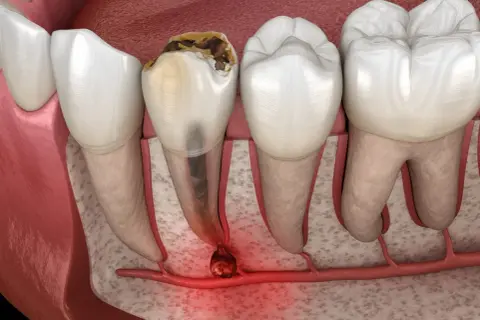 Zepsuty ząb z zapaleniem wierzchołka korzenia. To pokazuje, czym jest endodoncja – leczenie kanałowe.
