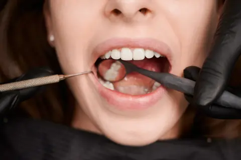 Uśmiech z widocznymi, białymi zębami, w tym siódemki, badany przez dentystę w czarnych rękawiczkach przy użyciu lusterka i sondy.