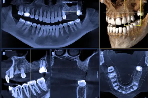CBCT co to? Wielopłaszczyznowe badanie zębów i szczęki, pokazujące szczegółowo strukturę kostną i uzębienie.