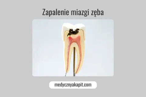 Model zęba z próchnicą i widoczną miazgą. Zapalenie miazgi zęba jak uśmierzyć ból.