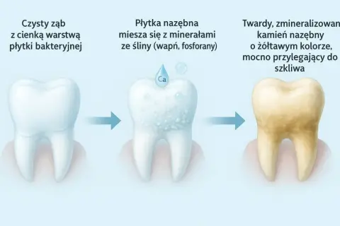 Ilustracja pokazuje, skąd się bierze kamień na zębach: płytka bakteryjna miesza się z minerałami ze śliny, tworząc twardy, żółtawy kamień nazębny.
