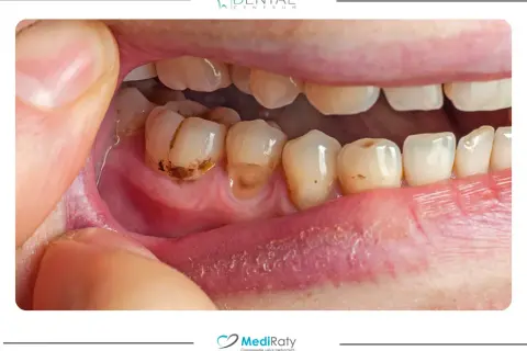 Domowe sposoby na próchnicę: Co naprawdę działa, zanim pójdziesz do dentysty?