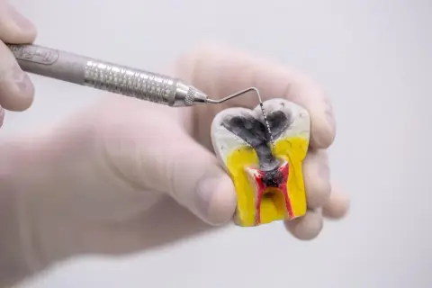 Model zęba z widoczną próchnicą zaawansowaną, gdzie narzędzie dentystyczne bada zniszczone tkanki.