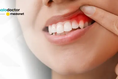 Stan zapalny dziąseł: Jak skutecznie leczyć w domu i u dentysty?