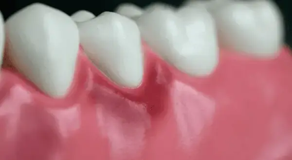 Zapalenie dziąseł: Ile trwa leczenie? Odpowiedź dentysty!