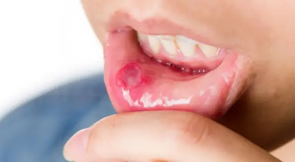Afta w ustach a dentysta: Czy wizyta jest możliwa? Decyzja krok po kroku